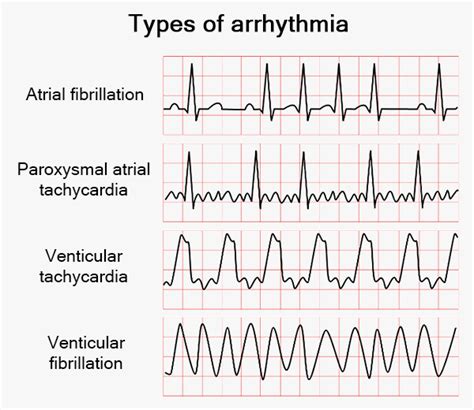 an irregular heartbeat figgerits answers|Heart arrhythmia .
